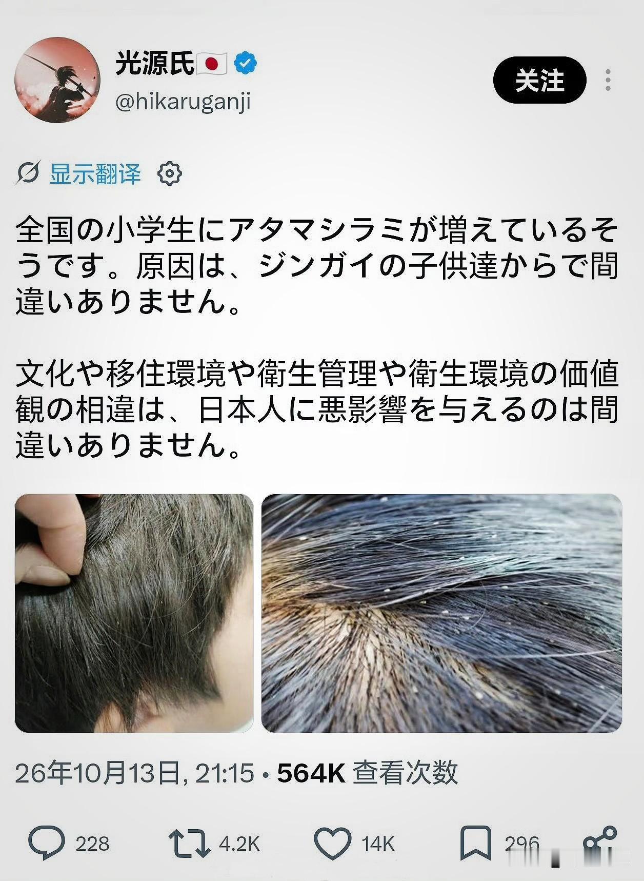 日本一博主发文称，日本小学生头虱变多了，这毫无疑问就是中国孩子带来的。还说什么观