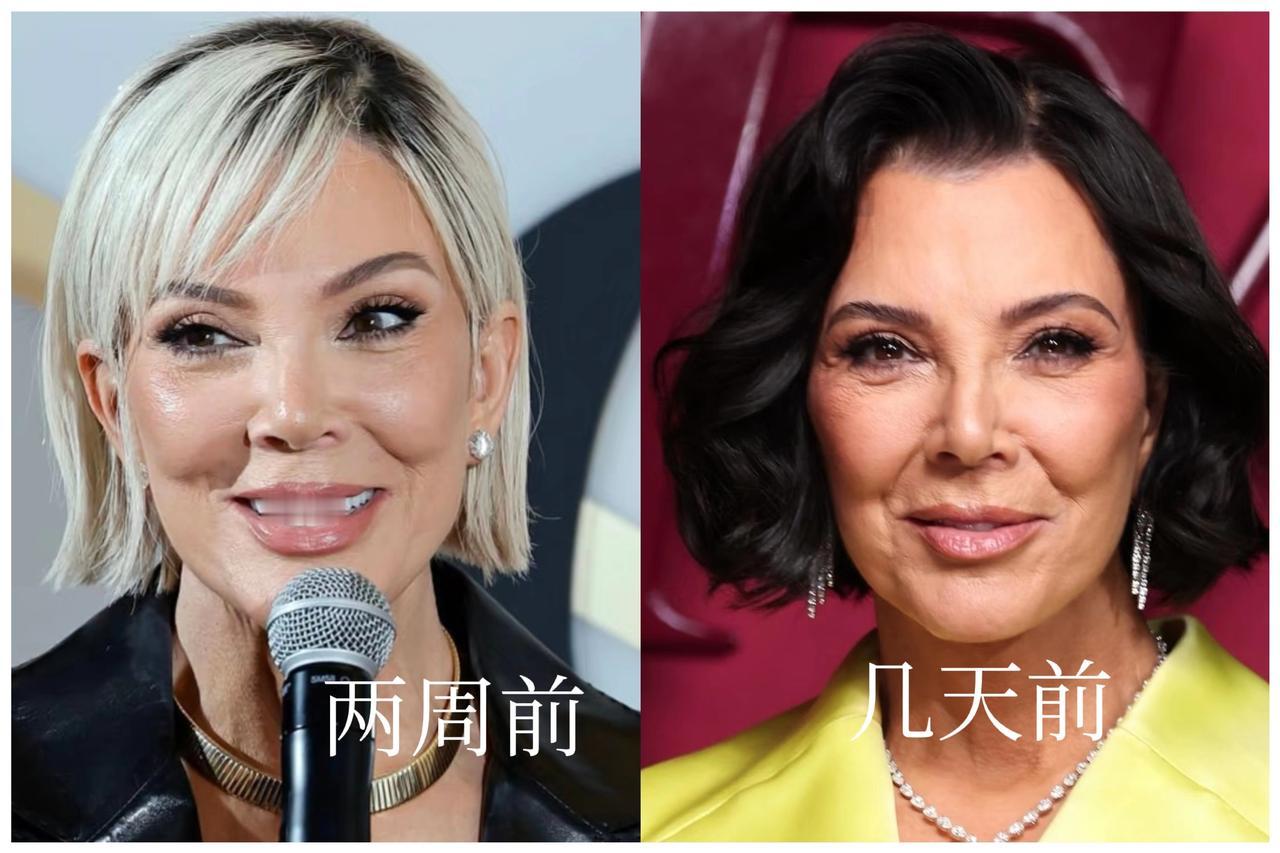 卡戴珊太后的脸又变回来了，百万美金做的拉皮，维持不到半年。左图是两周前生图，还