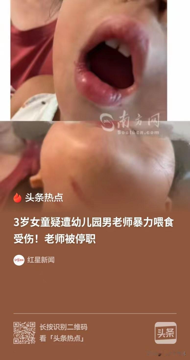 中山，三岁的小女孩在幼儿园不爱吃饭，男老师便暴力的喂她，结果把颈部和嘴唇都弄伤了