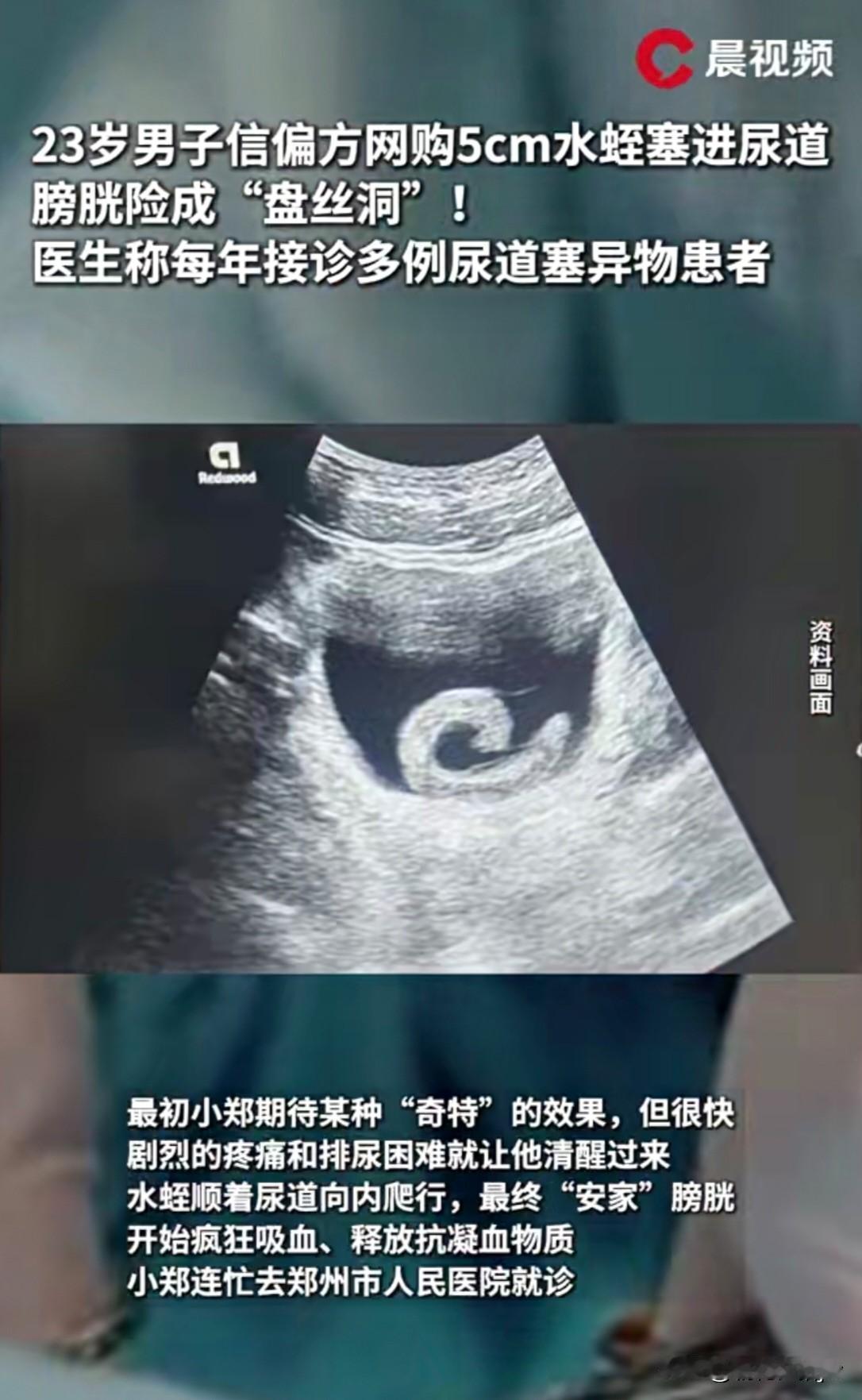 真是好奇害死猫！郑州23岁小郑听信“偏方”，出于好奇网购了一条5㎝水蛭，并将