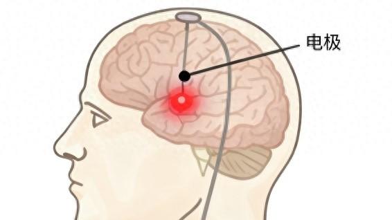 造福帕金森和精神疾病患者, 国产“脑起搏器”上市前临床首例手术完成