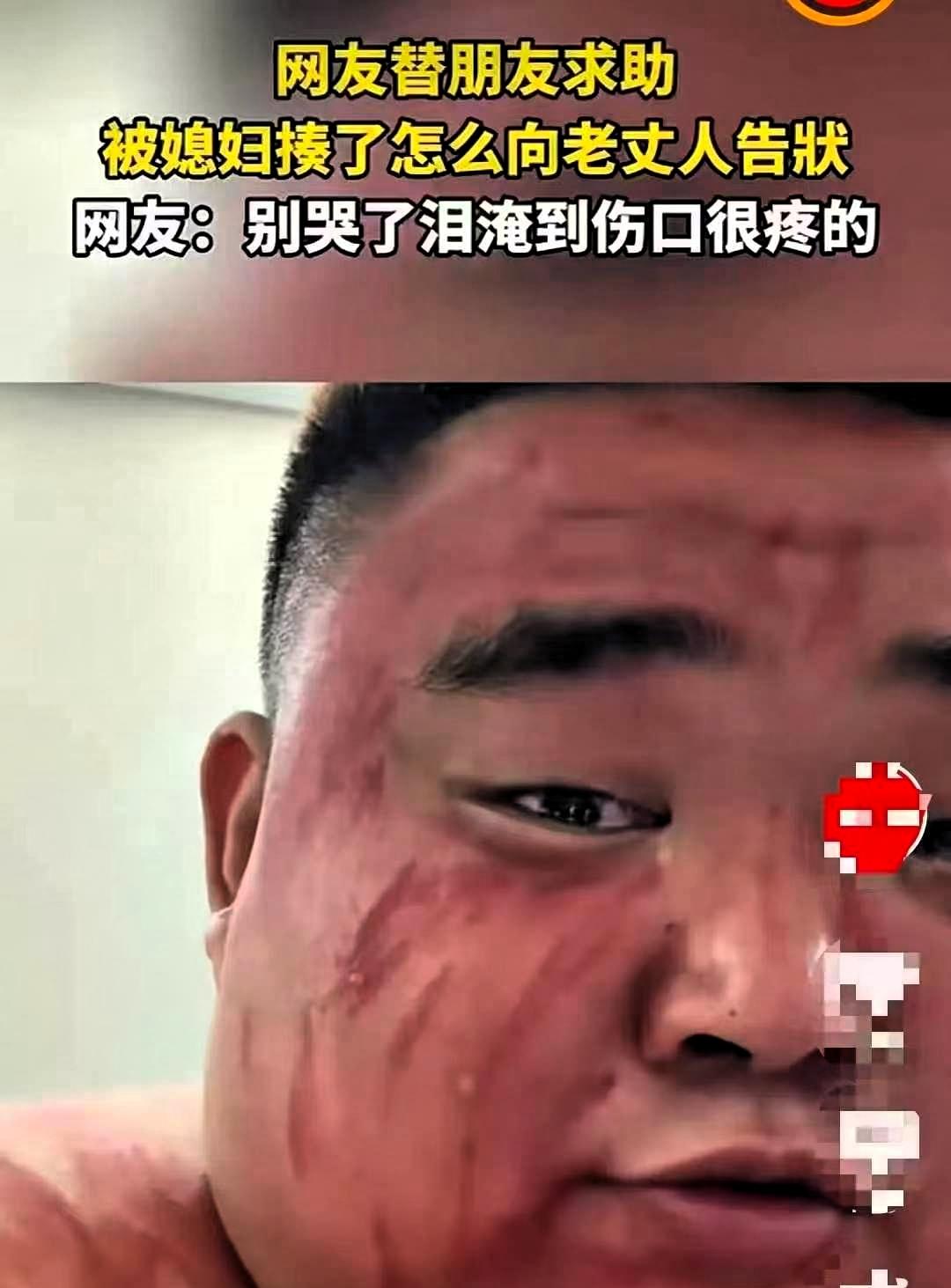 湖北，一男子被媳妇打了，脸上带着明显的伤痕，一大早跑到朋友家中倾诉委屈。看着脸上