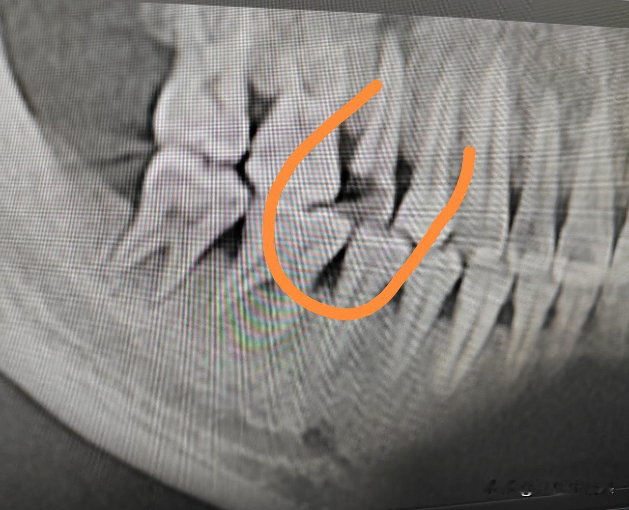这颗牙齿蛀牙了，缺失的有点严重，CT显示根尖也有炎症，三甲医院的医生直接说拔掉或