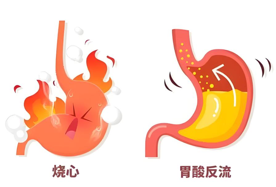 频繁出现反酸、烧心、胃胀、恶心想吐等不适症状，大概率是胃食管反流！想要精准确诊病
