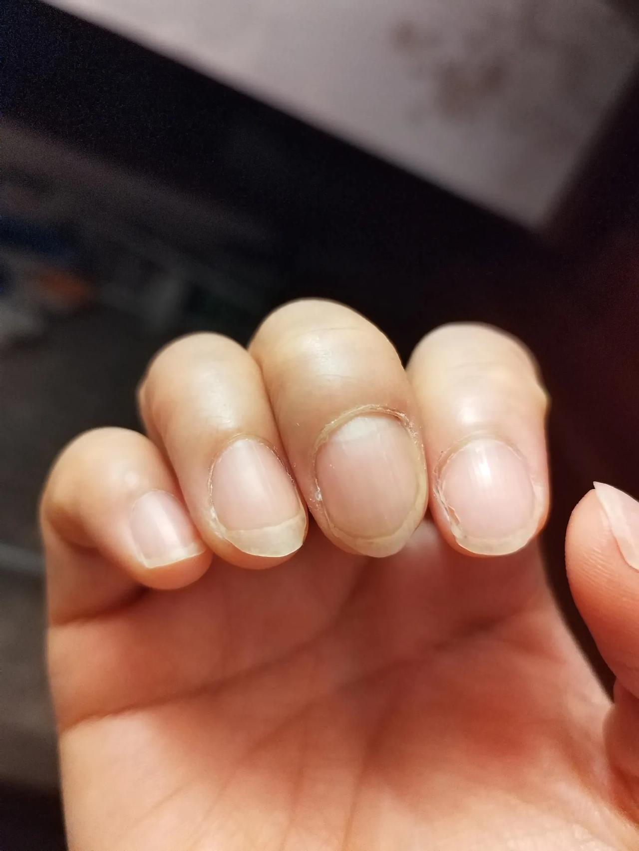 一次辛苦劳动治好了我的灰指甲。我的右手中指有个灰指甲，已经陪伴了我二十多年了，