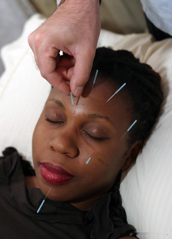 针灸治疗高血压（肝阳上亢型）临床医案患者信息：男性，52岁，企业职员。初