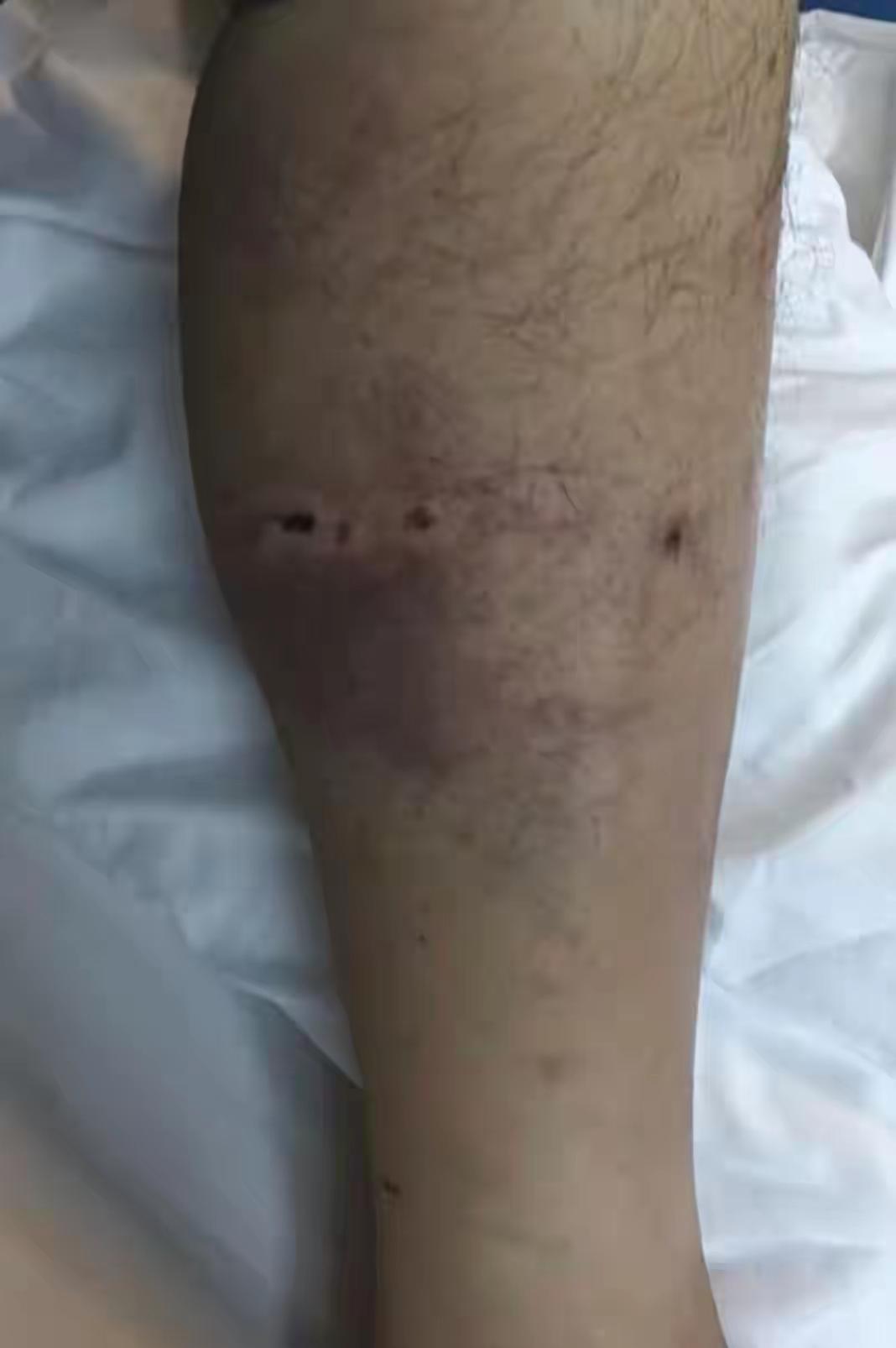 在山上采菌子时，重庆城口县一男子被黑熊袭击，这只黑熊重达200来斤，当男子和黑