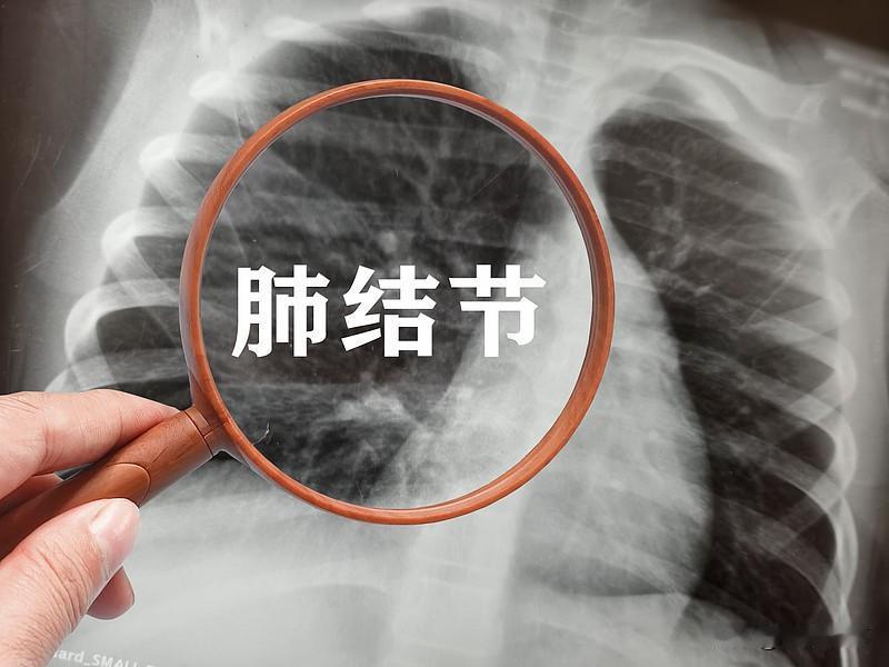 如何对待肺磨玻璃结节?发现肺磨玻璃结节先别慌。很多人一查出就吓得不行，其实大部