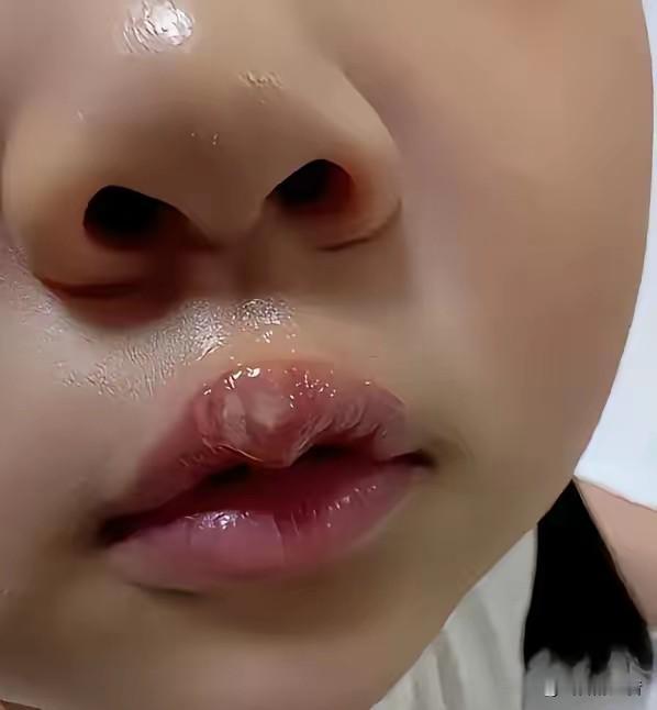 2026年5月27日，因幼儿上课说话，用热熔胶枪连续两次烫中班女童嘴唇，致其唇部