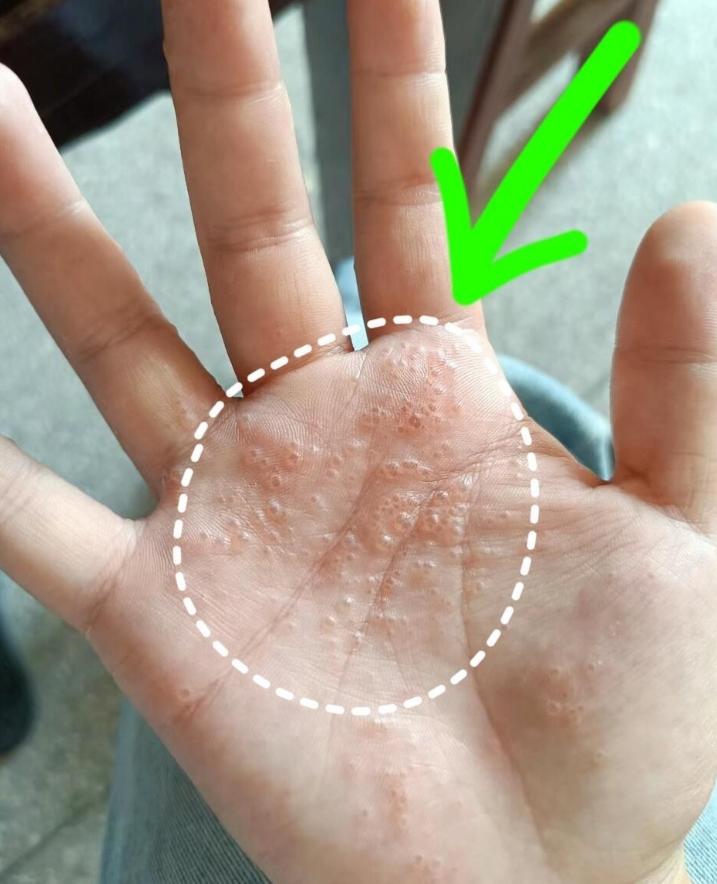 汗疱疹怎么治？西医就说是汗疱疹，中医就叫做湿疹，说到湿疹呢，肯定是跟水湿有关