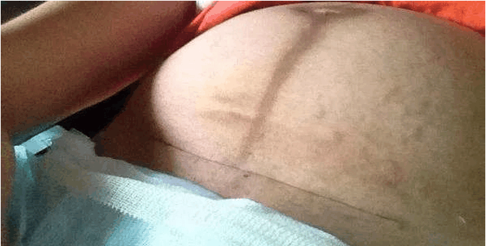 产妇生产过后坐月子, 肚子却又一天天变大, 检查后得知原因, 让人心痛不已