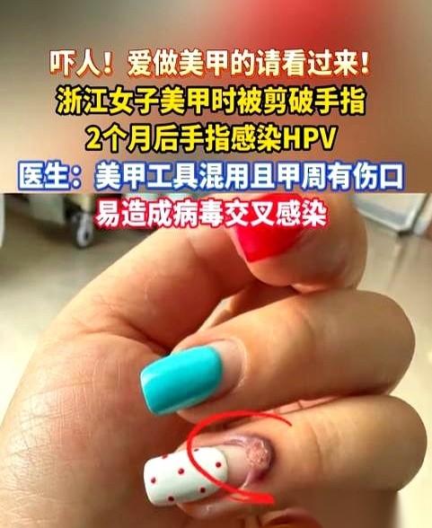 杭州一个姑娘，在美甲店剪死皮，剪子轻轻划了一下。一个几乎看不见的小口子。她和美