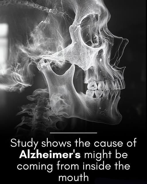 阿尔茨海默病可能与牙龈细菌有关，新研究显示。科学家们反复在死于阿尔茨海默病的患者