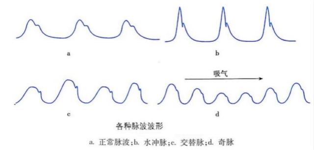 脉搏波形种类比较多,这里只举几个典型例子说明.