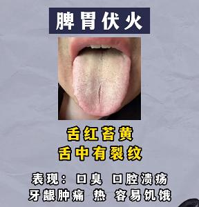 你的舌苔有裂纹吗？