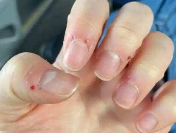 悲剧还是发生了！近日，浙江杭州，一男子见手指长了个“倒刺”，就顺手拔掉了，结果第