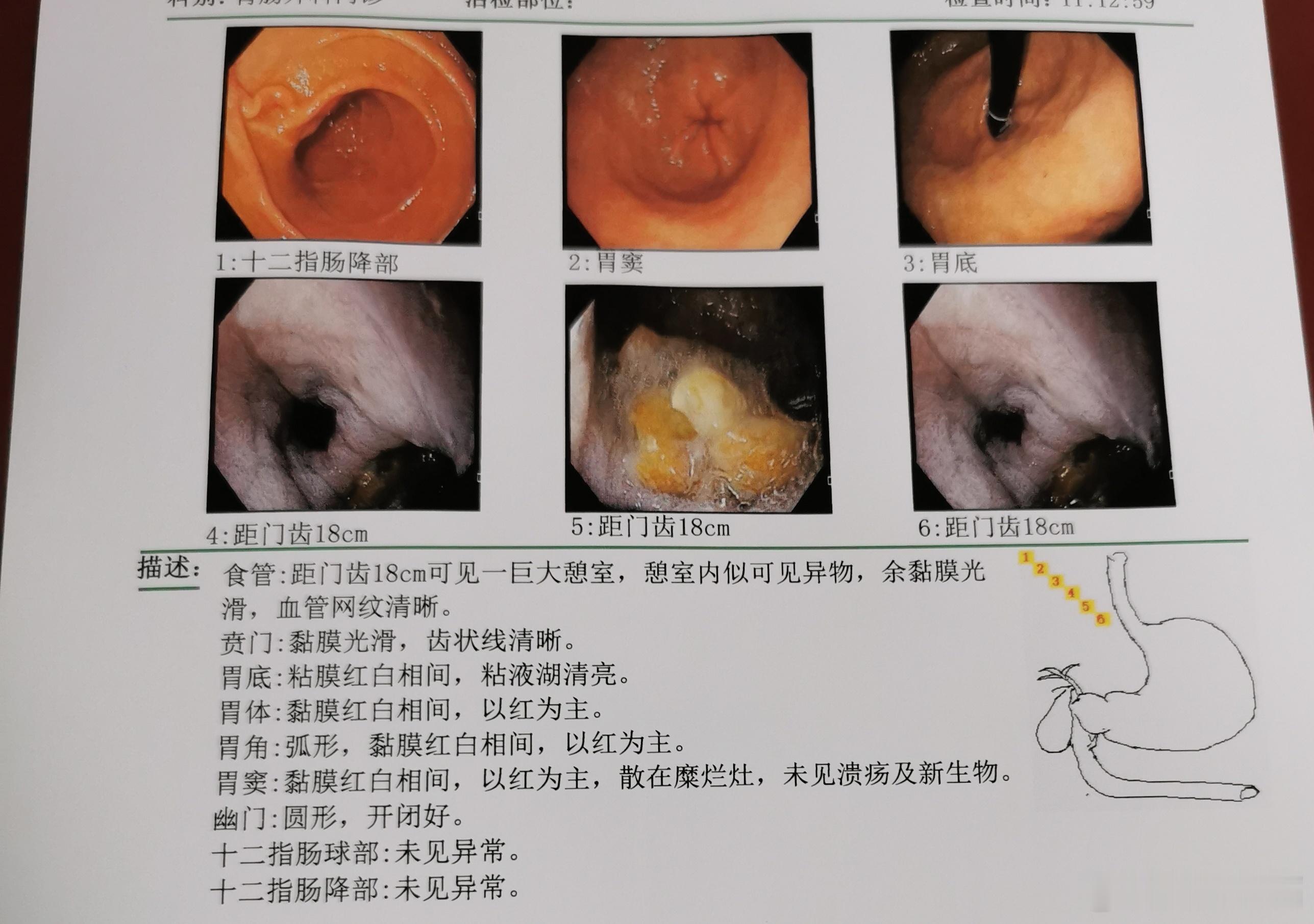 食管憩室是食管壁的局限性膨出，形成与食管腔相通的囊袋，诊治方式如下：诊断症状