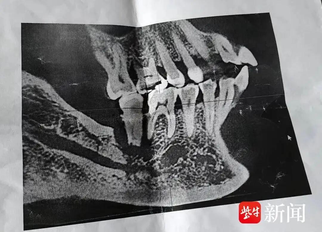 “吃相太难看了！”江苏南京，一女子去医院拔牙，却花了1000多元，她觉得贵的离谱