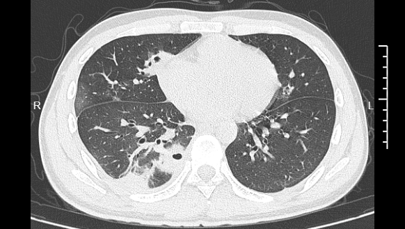 男生肺被“啃”出10多个空洞! 网友: 原来我真的命大