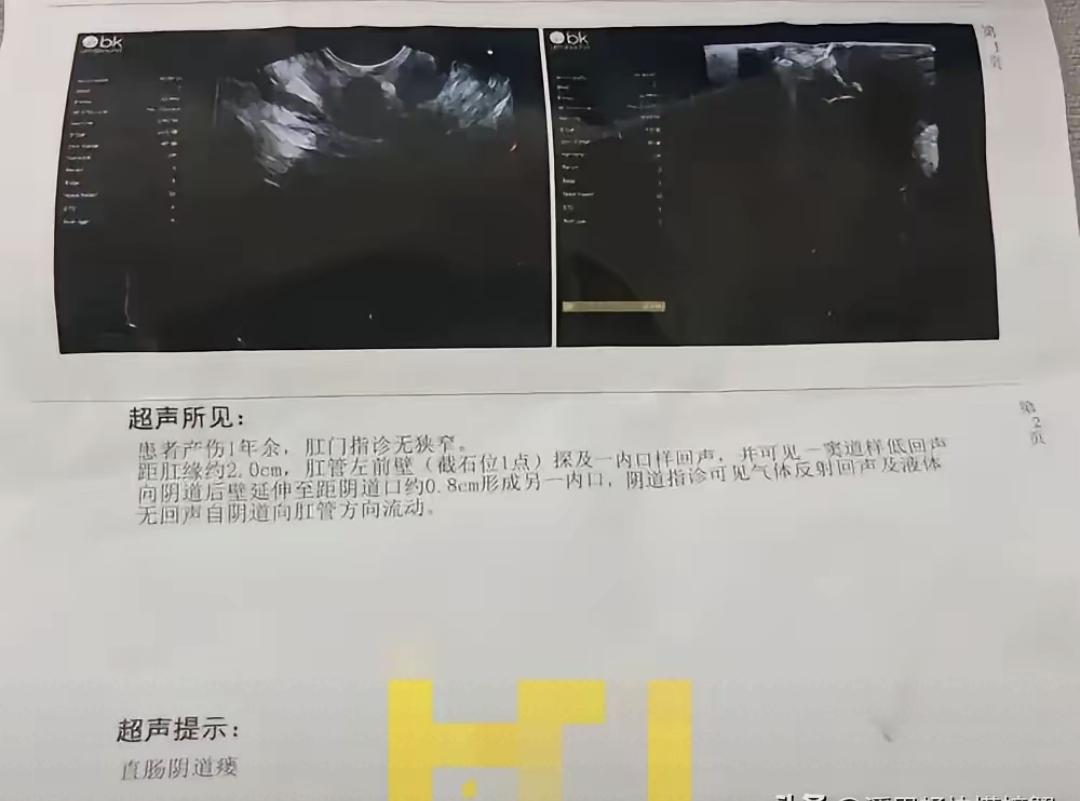 顺产第三天，大便从阴道流出来，医生却说“没事”。李霞在任丘市人民医院生完孩子，