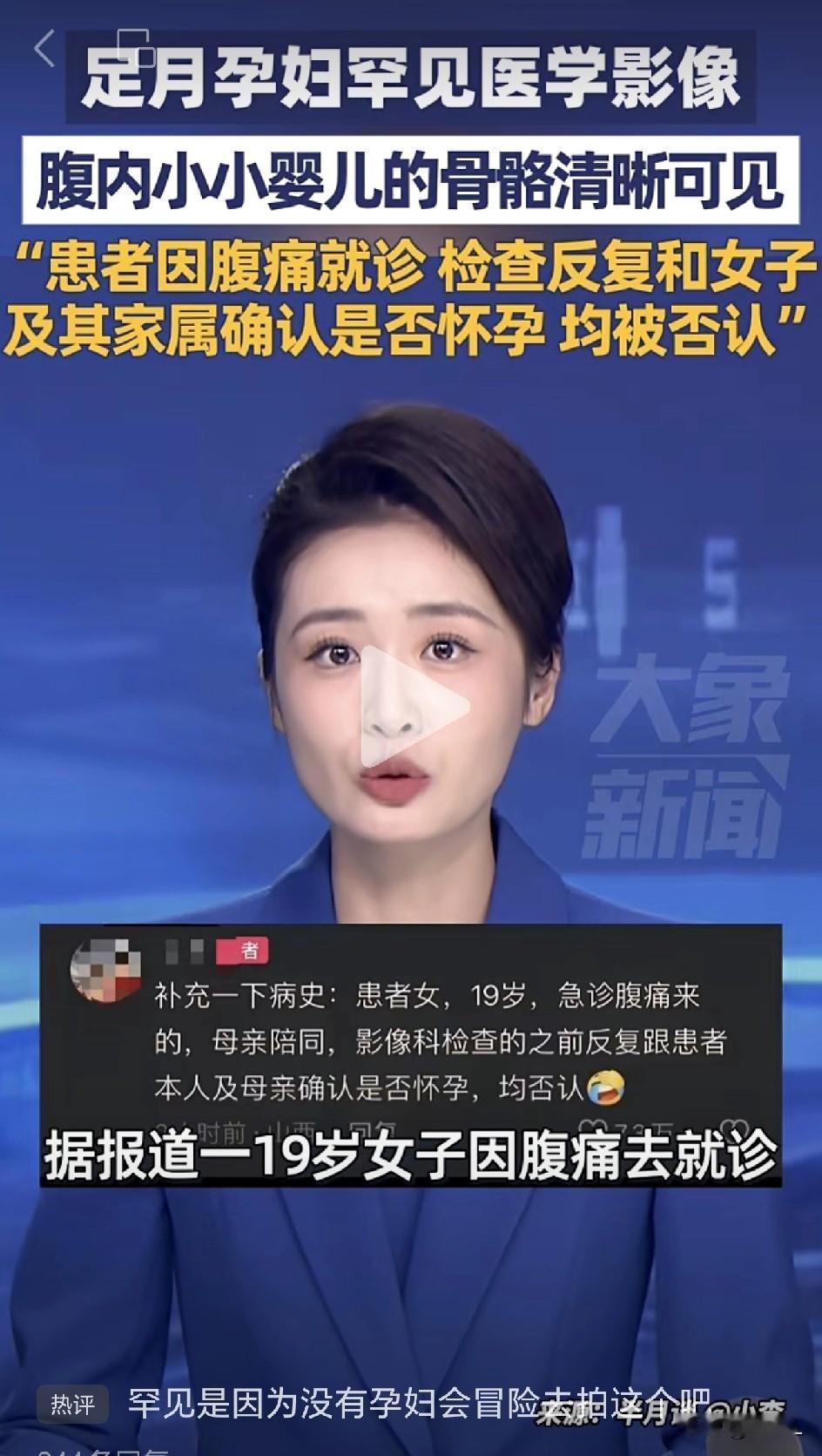 “我没怀孕！”19岁少女坚称，CT结果却让医生惊呆了：腹中藏着足月宝宝！婴儿骨骼
