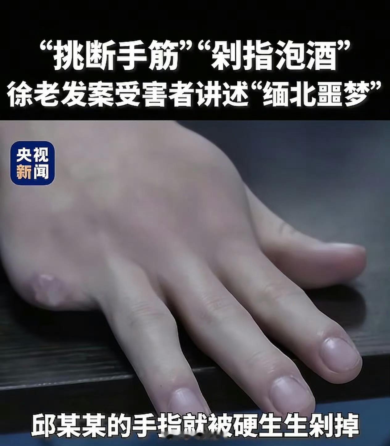 缅北电诈园区剁人手指泡酒卧槽！真特么残忍，毫无人性！​​​