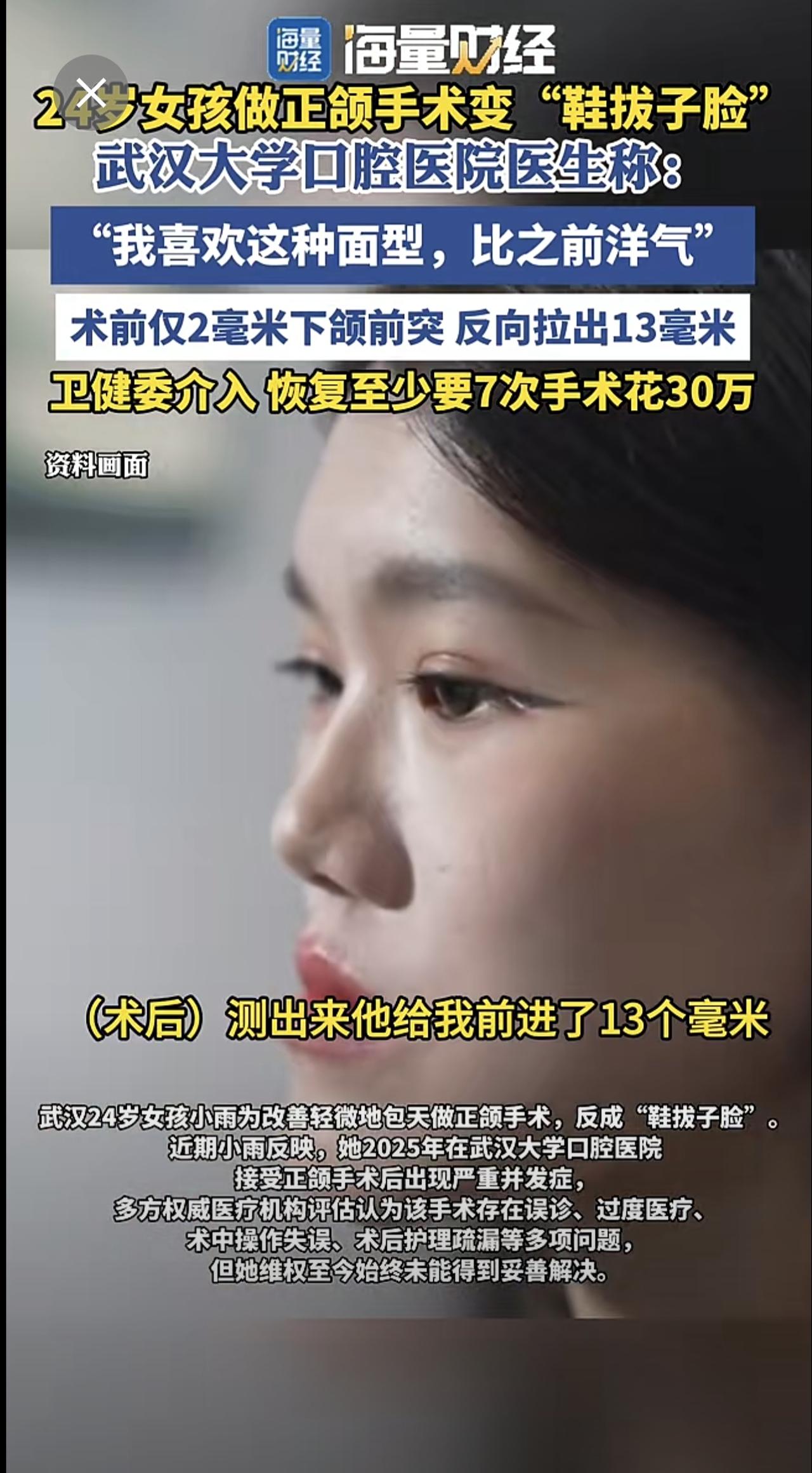 24岁女孩做正颌手术变“鞋拔子脸”，武汉大学口腔医院医生称：“我喜欢这种面型，比