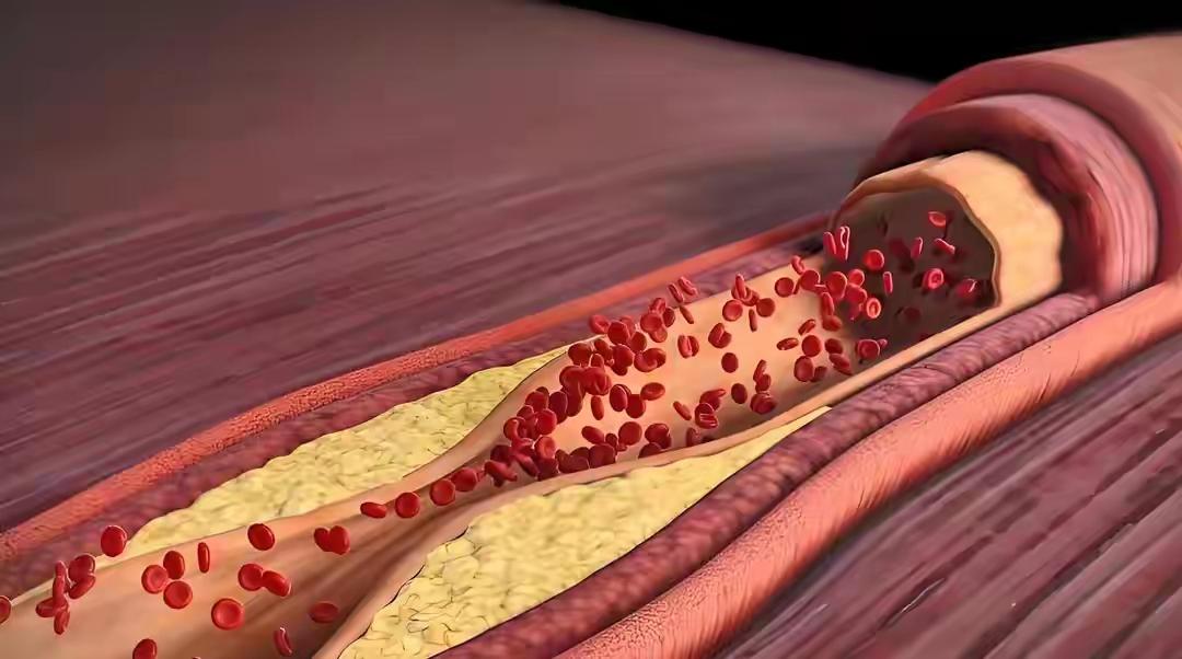 这4个指标正常，证明你的血脂基本没毛病，不用盲目去检查了内容严格依据《中国成
