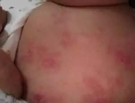这些都不是婴儿湿疹, 妈妈们一定要记住! (请看图)