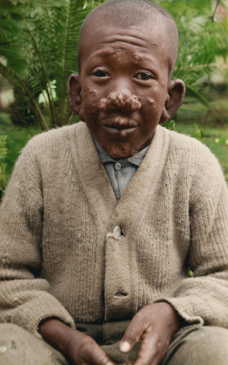 江门麻风病院，一位麻风病男孩正坐在户外，直面镜头的模样。他的面部被麻风病彻底改