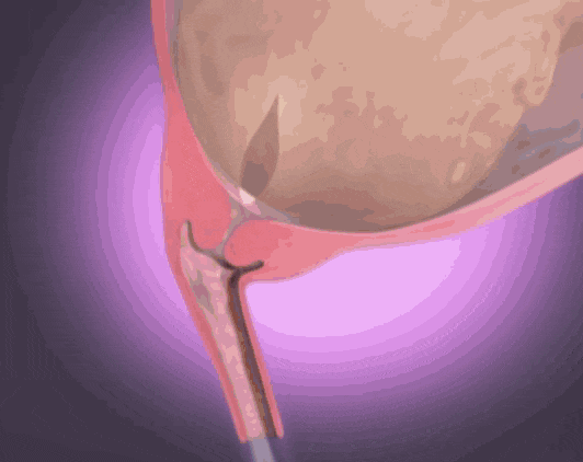 产前阵痛是分娩进行的紧张一步,准妈妈要尽速到医院待产