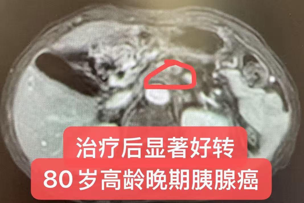 晚期胰腺癌的治疗：个案分享。患者女性，80岁。既往体健，确诊胰腺癌，疾...