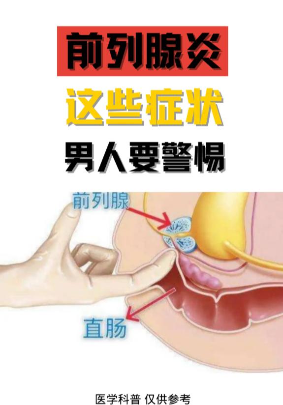 前列腺炎这些症状，男人要警惕