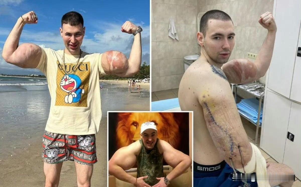 俄罗斯“大力水手”注射药物使二头肌异常发达，如今可能因可怕的感染而失去双臂——《