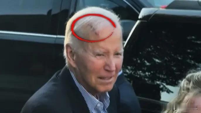 拜登接受癌症放射治疗，前列腺癌已扩散至骨头美国前总统拜登开始放射治疗，前列腺癌