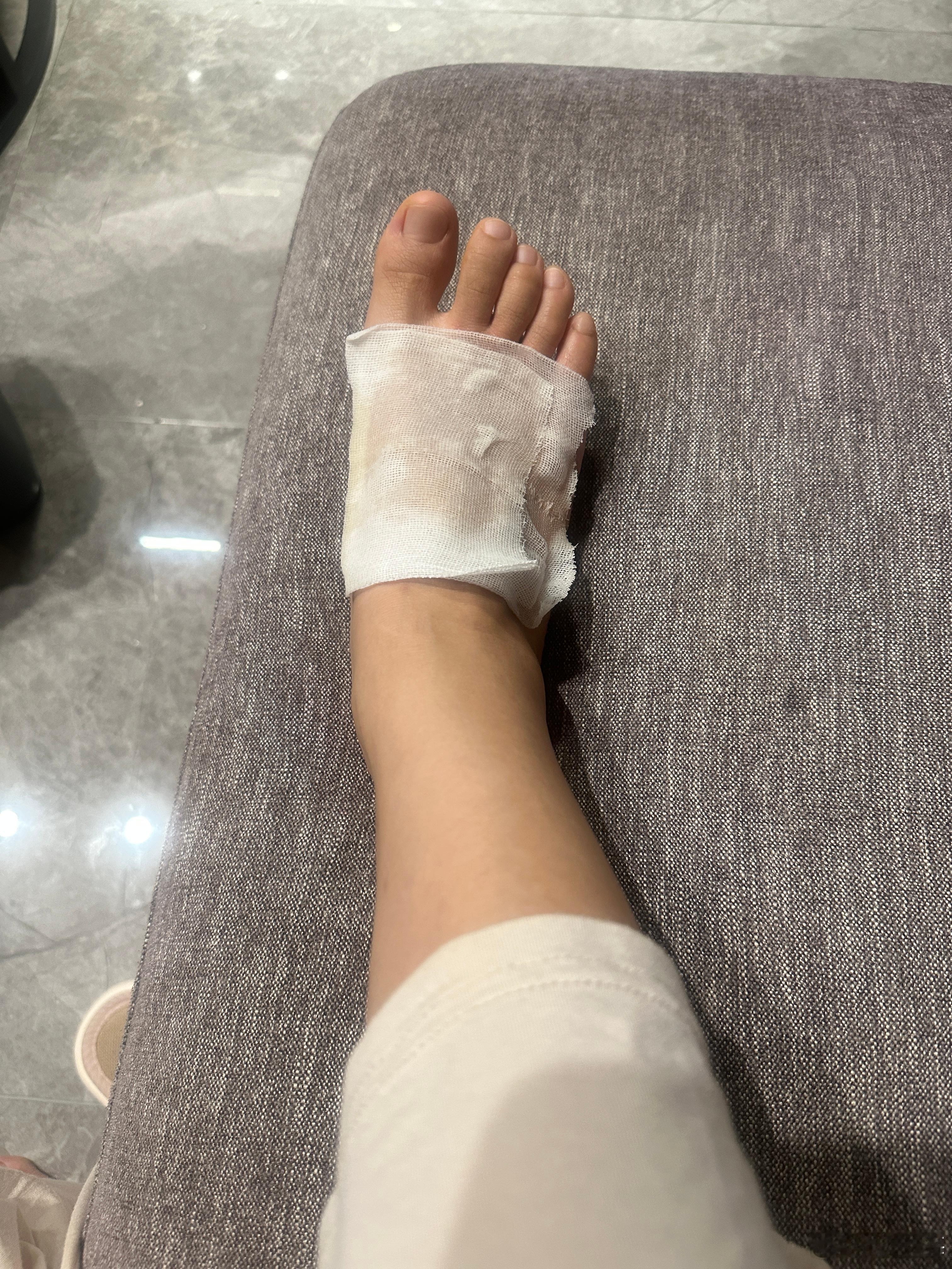 关于昨晚被我亲老公用刚烧开的水烫到脚背这一事件，真是惨绝人寰，本是好心给我加热水