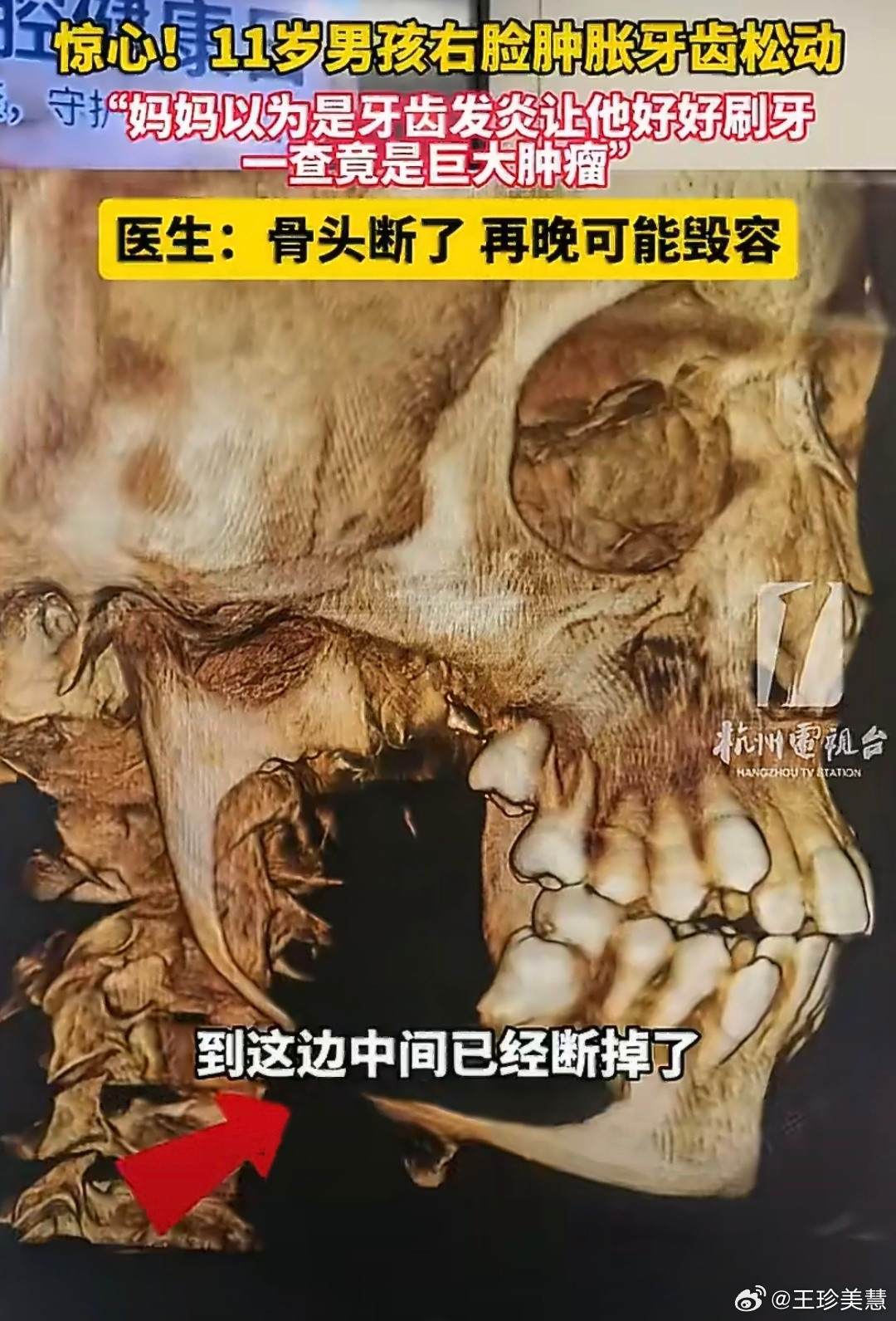 11岁男孩脸肿竟是肿瘤骨头断了我的天啊如果小孩子脸两侧肿了一定要去检查大多数家长