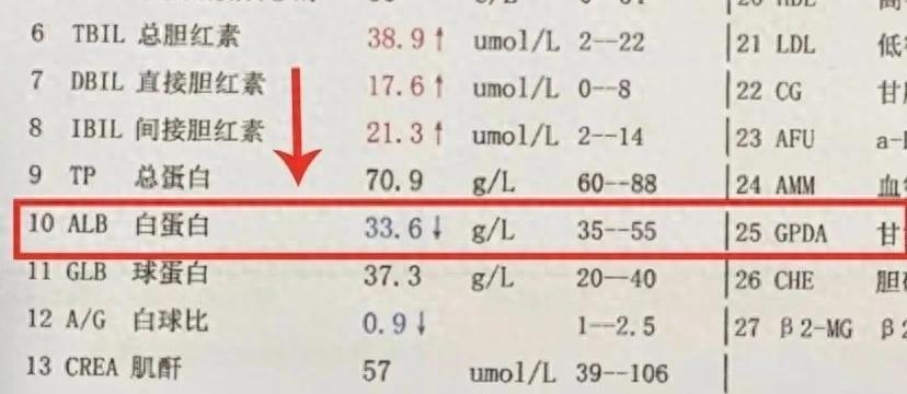 肝功能单上，这三个指标正常，肝脏才算真的“没硬”！肝功能检查单上那些密密麻麻