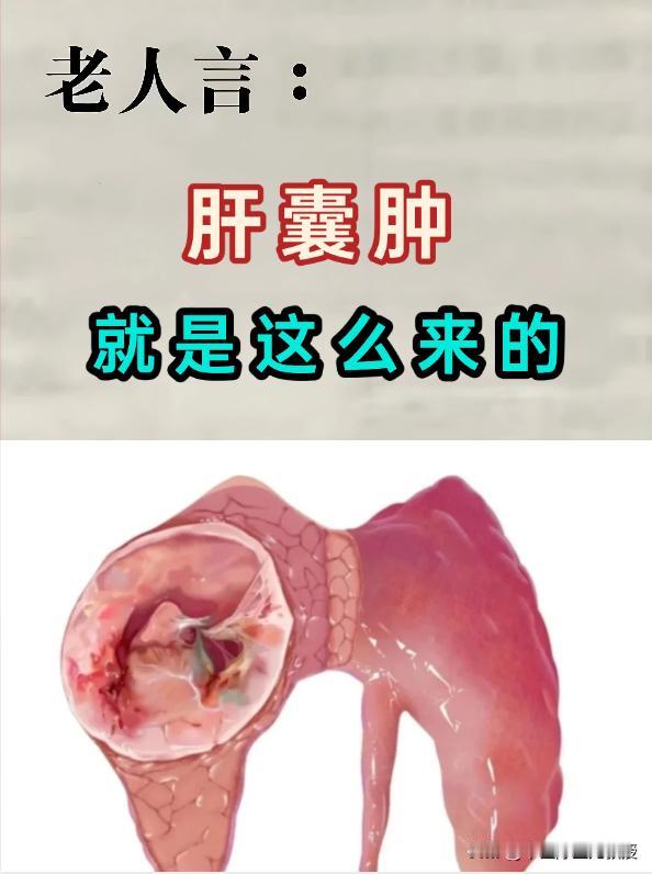 肝囊肿，这么来的治了一辈子肝囊肿，一分钱没赚到！今天我就把肝囊肿的真相说出来