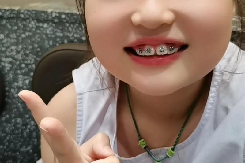0岁女儿牙齿正畸术日记：犹豫了半年，调查了半年，这两天终于给女儿把牙齿🦷