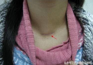 一家三口先后查出患甲状腺癌, 餐桌上经常出现的这道菜竟是元凶!