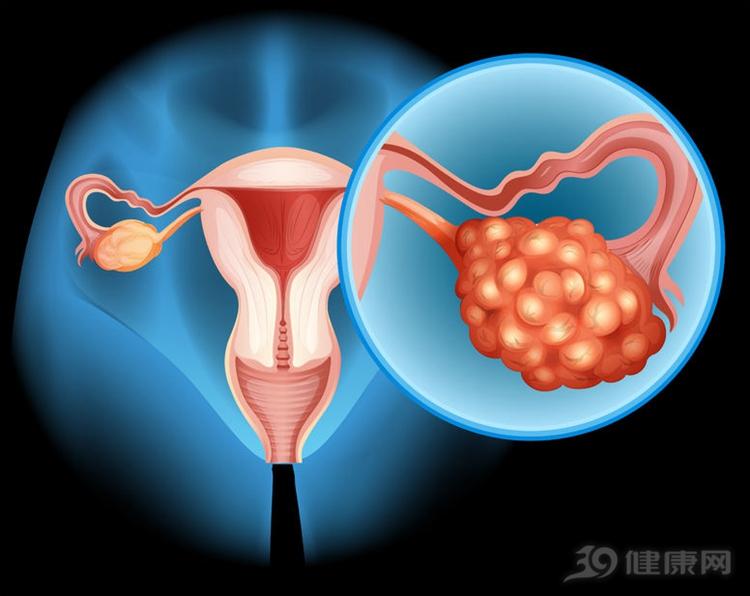 得了卵巢癌怎么治? 这5个方法帮你延长生命!