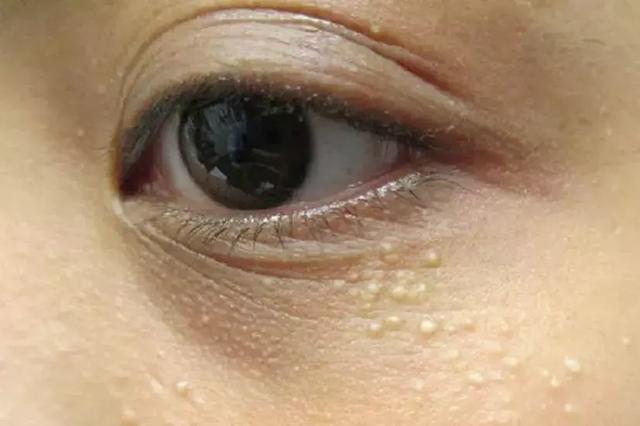 眼睛周围的小粒粒, 真是眼霜惹的祸? 最好的消除方法是……