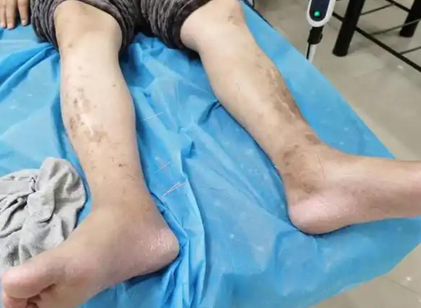 成功护骨后，骨头还能恢复坚硬吗？建议：补维D别超过这个岁数说到骨骼健康，很多