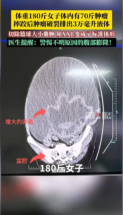 “万万没想到！”5月11日报道，浙江，一女子体重180多斤，肚子很大，一直致力于