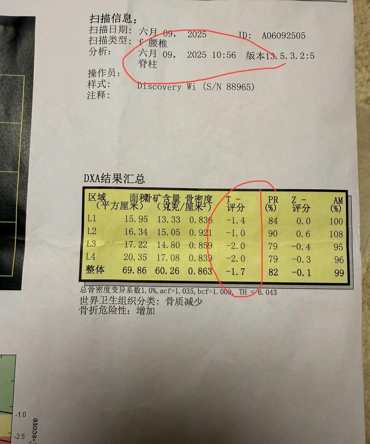 因为连续吃了十几年的优甲乐，我又不喜欢吃钙片尤其又是家族遗传，再加上我因为胳膊问