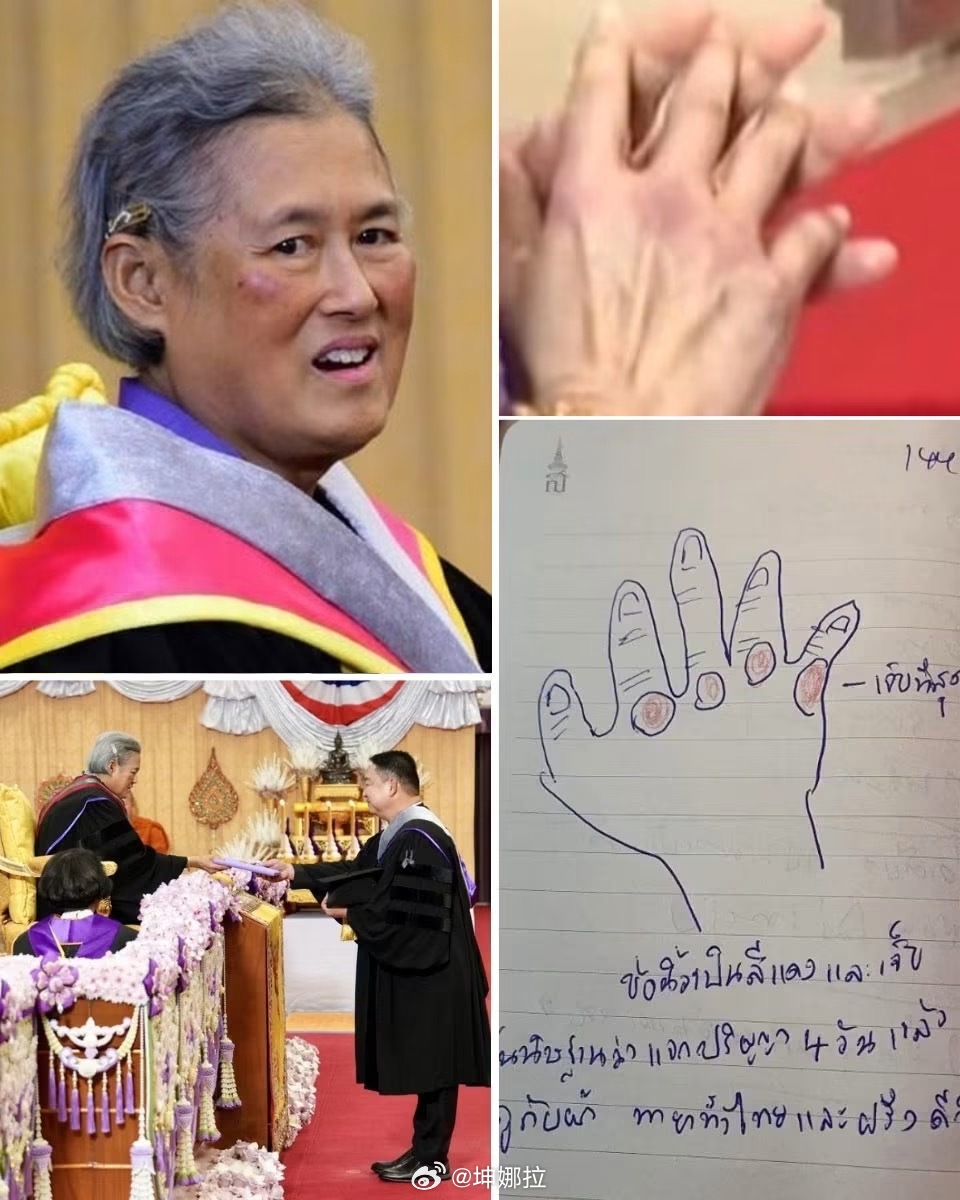 诗琳通公主画下手部伤痕又是一年毕业季！泰国诗琳通公主曾连续4天主持毕业典礼、为