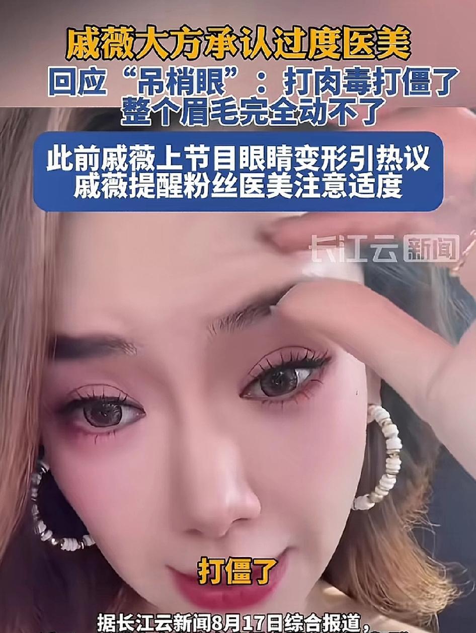最近戚薇又大方的承认了自己确实是过度医美了，打肉毒打僵了，现在整个眉毛都完全动不