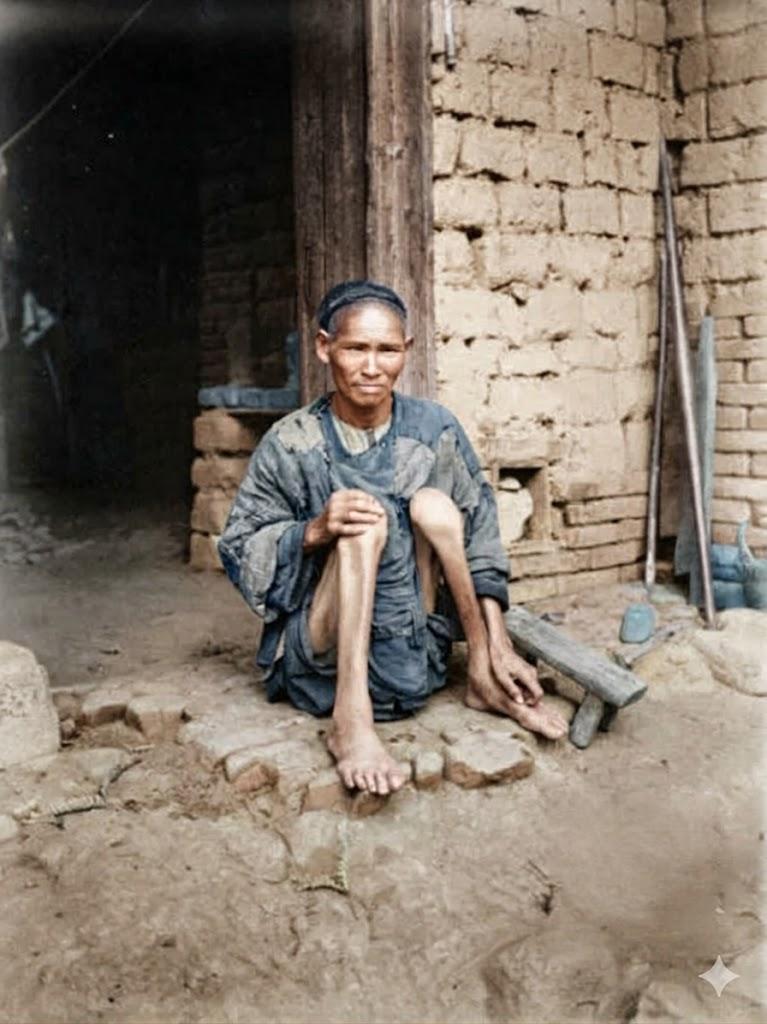 这张照片是晚清时期一位身患肌肉萎缩的底层男子，男子骨瘦如柴，腿部肌肉严重萎缩，细