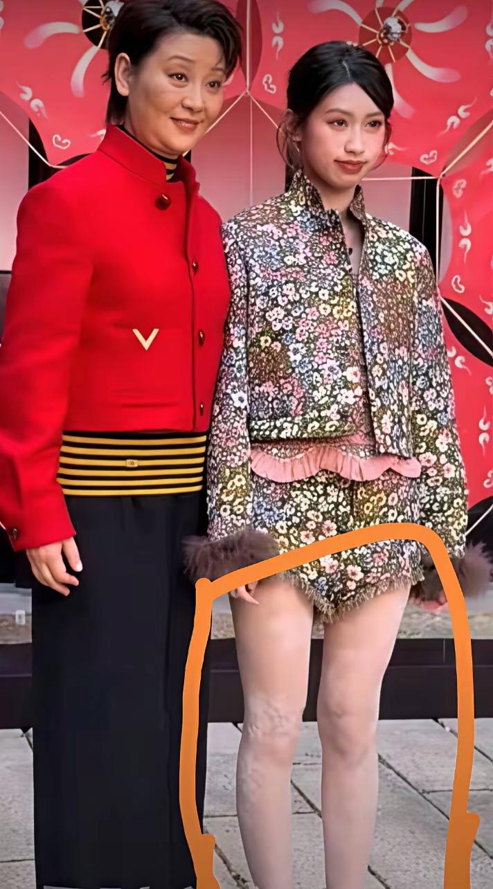 有网友发布第一张照片后，提出了这样一个问题：白癫风会遗传吗？查了一下百度，百度